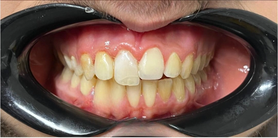 Avant traitement soins dentaires BioDental Annaba